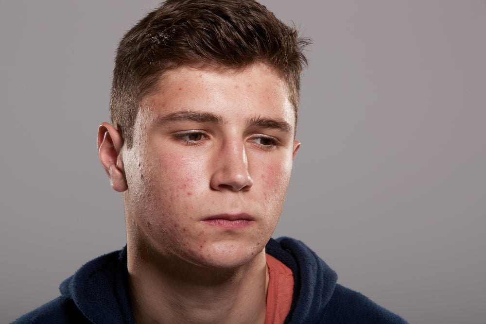 does acne cause depression? new studies confirm the link!